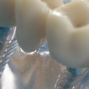 Implantate aus Titan, Andreas Hager, Zahnarzt Burbach