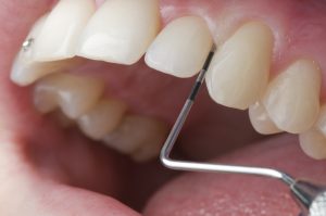 Parodontitisbehandlung in der Zahnarztpraxis Andreas Hager, Burbach
