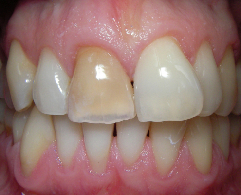 Vor internem Bleaching Vor internem Bleaching