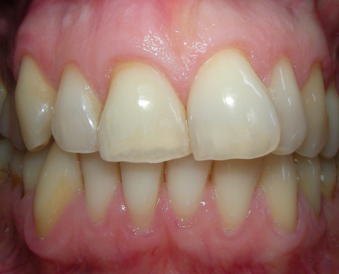 Nach internem Bleaching Nach internem Bleaching