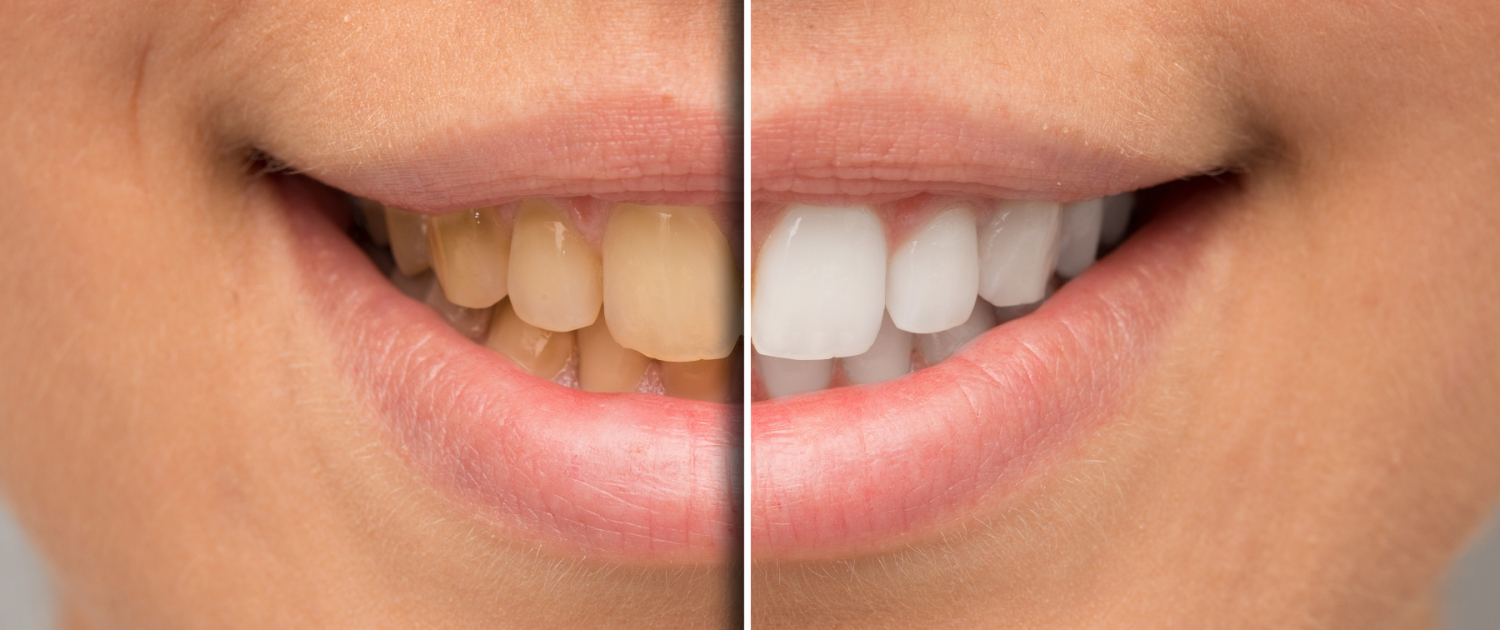 Bleaching oder Zahnaufhellung ist eine schonende Methode, Zähne heller und strahlender wirken zuu lassen